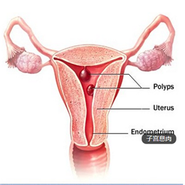 女性子宫息肉的症状