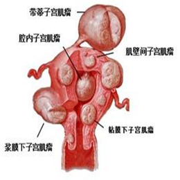 子宫肌影响生育吗