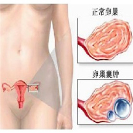 右侧附件囊肿怎么办