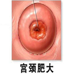 宫颈肥大更青睐哪类女性