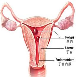 怎样预防宫颈息肉