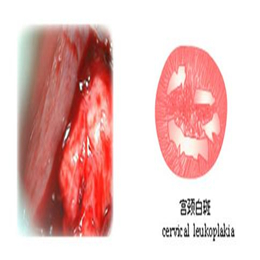 宫颈白斑危害
