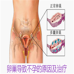卵巢性不孕治疗黄金时间