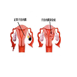 子宫内膜息肉症状有哪些