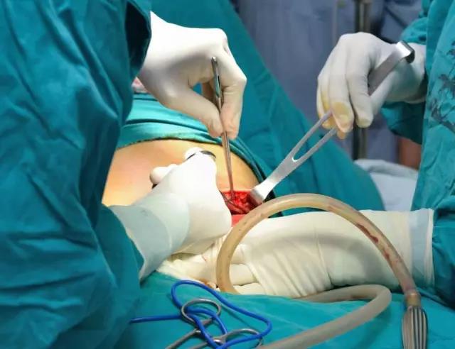 剖腹产3.jpg